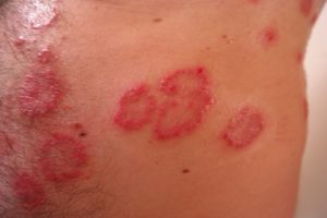 psoriasis